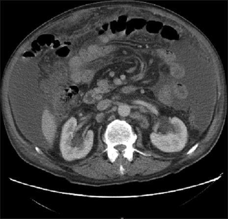 CT scan of the abdomen showing omental cake.